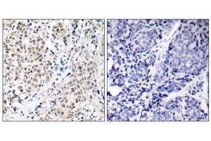 Immunohistochemical analysis of paraffin- embedded human breast carcinoma tissue using Myc (Ab-358) antibody (E021035). (c-MYC Antikörper)