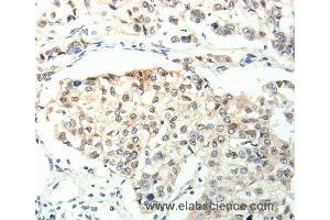 Immunohistochemistry of Human breast cancer using TPM2 Polyclonal Antibody at dilution of 1:60 (TPM2 Antikörper)