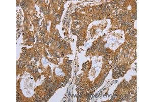 Immunohistochemistry of Human gastric cancer using NLRP10 Polyclonal Antibody at dilution of 1:45