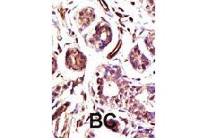 Formalin-fixed and paraffin-embedded human cancer tissue reacted with UBE3A polyclonal antibody  , which was peroxidase-conjugated to the secondary antibody, followed by DAB staining . (ube3a Antikörper  (C-Term))