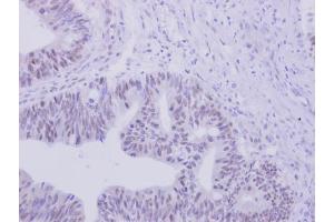 IHC-P Image ZNF45 antibody [N2C3] detects ZNF45 protein at nucleus on human colon carcinoma by immunohistochemical analysis.
