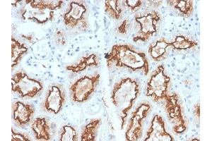 Formalin-fixed, paraffin-embedded human Renal Cell Carcinoma stained with RCC Rabbit Recombinant Monoclonal Antibody (CA9/2993R). (Rekombinanter CA9 Antikörper)