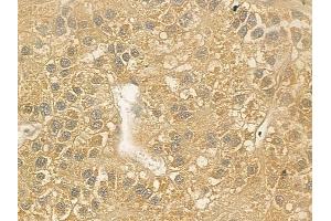 ABIN6262563 and ABIN6276905 at 1/100 staining human hepatocellular carcinoma by IHC-P. (IL2RG Antikörper  (N-Term))