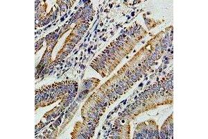 Immunohistochemical analysis of PIBF staining in human colon cancer formalin fixed paraffin embedded tissue section. (PIBF1 Antikörper)