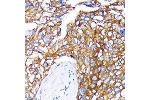 Immunohistochemistry of paraffin-embedded human liver cancer using Leptin Receptor Rabbit mAb (ABIN7268210) at dilution of 1:100 (40x lens). (Leptin Receptor Antikörper)