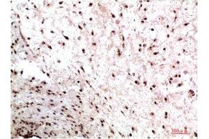 Immunohistochemical analysis of paraffin-embedded Human Colon Carcinoma Tissue using HP-1γ Mouse mAb diluted at 1:200. (CBX3 Antikörper)