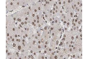 ABIN6267529 at 1/200 staining human liver cancer tissue sections by IHC-P. (SAPK, JNK (pTyr185) Antikörper)