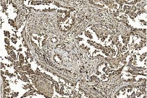 Immunohistochemical analysis of paraffin-embedded Human Lung adenocarcinoma section using Pink1 am1200a. (SUMO1 Antikörper)