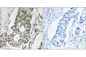 Immunohistochemistry analysis of paraffin-embedded human breast carcinoma tissue, using RIMS4 Antibody. (RIMS4 Antikörper  (AA 33-82))