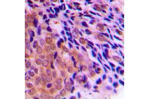 Immunohistochemical analysis of CLOCK staining in human prostate cancer formalin fixed paraffin embedded tissue section. (CLOCK Antikörper  (Center))