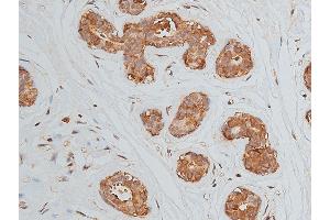 ABIN6269228 at 1/50 staining human breast cancer tissue by IHC-P. (VEGFR2/CD309 Antikörper)