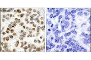 Immunohistochemistry analysis of paraffin-embedded human breast carcinoma tissue, using BRCA1 (Ab-1423) Antibody. (BRCA1 Antikörper  (AA 1391-1440))