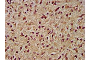 IHC image of ABIN7173964 diluted at 1:400 and staining in paraffin-embedded human glioma performed on a Leica BondTM system. (INPP5B Antikörper  (AA 78-178))
