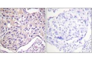 Immunohistochemistry analysis of paraffin-embedded human breast carcinoma, using GRK2 (Phospho-Ser29) Antibody.