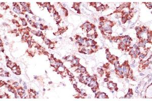 Immunohistochemistry of paraffin-embedded Human thyroid cancer using RPL24 Polyclonal Antibody at dilution of 1:100 (40x lens). (RPL24 Antikörper)