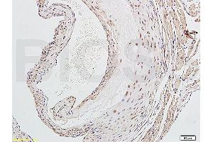 Formalin-fixed and paraffin embedded human endometrium carcinoma labeled with Rabbit Anti-NFKB p65 Polyclonal Antibody (ABIN668961), Unconjugated at 1:200 followed by conjugation to the secondary antibody and DAB staining. (NF-kB p65 Antikörper  (AA 51-100))