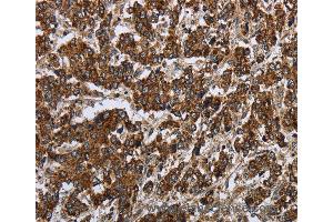 Immunohistochemistry of Human liver cancer using PPP1R13L Polyclonal Antibody at dilution of 1:30 (PPP1R13L Antikörper)