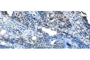 Immunohistochemistry of paraffin-embedded Human cervical cancer tissue using SAA4 Polyclonal Antibody at dilution of 1:35(x200) (SAA4 Antikörper)