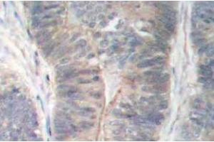 Immunohistochemistry (IHC) analyzes of p-PKR antibody in paraffin-embedded human colon carcinoma tissue. (EIF2AK2 Antikörper  (pThr451))