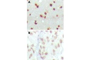 Immunohistochemical analysis of paraffin-embedded human cerebra (A) and lung carcinoma (B) tissue using MDM4 monoclonal antobody, clone 2D10F4 , showing nuclear localization with DAB staining. (MDM4-binding Protein Antikörper)