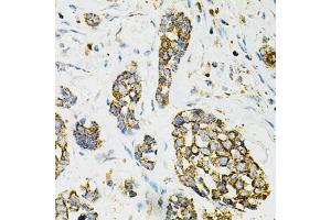 Immunohistochemistry of paraffin-embedded human esophageal cancer using ADSS antibody (ABIN6292806) at dilution of 1:100 (40x lens). (ADSS Antikörper)