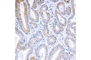 Immunohistochemical analysis of ARF4 staining in human colon cancer formalin fixed paraffin embedded tissue section. (ARF4 Antikörper  (Center))