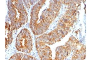 Formalin-fixed, paraffin-embedded human Colon Carcinoma stained with TNFS15 / VEGI Monoclonal Antibody (VEGI /1283). (TNFSF15 Antikörper)