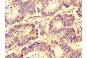 Immunohistochemistry of paraffin-embedded human colon cancer using ABIN7153920 at dilution of 1:100 (SLC37A1 Antikörper  (AA 245-302))