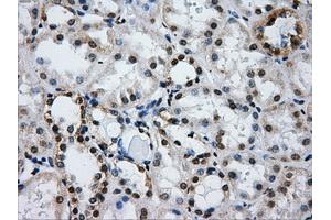 Immunohistochemical staining of paraffin-embedded Carcinoma of liver tissue using anti-IFIT3mouse monoclonal antibody. (IFIT3 Antikörper)