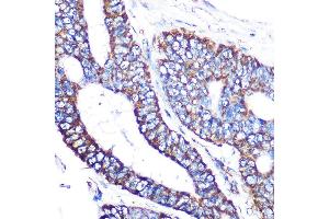 Immunohistochemistry of paraffin-embedded human colon carcinoma using MTCO2 Rabbit mAb (ABIN7266638) at dilution of 1:100 (40x lens). (COX2 Antikörper)