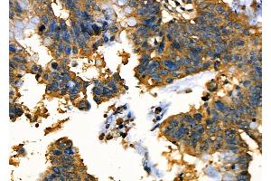 ABIN6263792 and ABIN6277681 at 1/100 staining Human ovarian cancer by IHC-P.