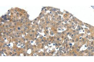 Immunohistochemistry of paraffin-embedded Human esophagus cancer tissue using SCN11A Polyclonal Antibody at dilution 1:40