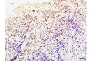 Formalin-fixed and paraffin embedded Human endometrium carcinoma labeled Anti-Livin Polyclonal Antibody, Unconjugated  at 1:200, followed by conjugation to the secondary antibody and DAB staining (BIRC7 Antikörper  (AA 101-200))