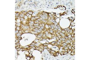 Immunohistochemistry of paraffin-embedded human colon carcinoma using TR antibody (ABIN3023477, ABIN3023478, ABIN3023479 and ABIN6220053) at dilution of 1:50 (40x lens). (TRAF7 Antikörper)