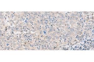Immunohistochemistry of paraffin-embedded Human cervical cancer tissue using ABHD17B Polyclonal Antibody at dilution of 1:35(x200) (ABHD17B Antikörper)