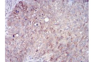 Immunohistochemical analysis of paraffin-embedded cervical cancer tissues using RAB11FIP1 mouse mAb with DAB staining. (RAB11FIP1 Antikörper  (AA 130-271))