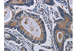 The image on the left is immunohistochemistry of paraffin-embedded Human colon cancer tissue using ABIN7191804(PCDHAC1 Antibody) at dilution 1/50, on the right is treated with synthetic peptide. (PCDHAC1 Antikörper)