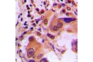 Immunohistochemical analysis of BRCA1 (pS1423) staining in human lung cancer formalin fixed paraffin embedded tissue section. (BRCA1 Antikörper  (C-Term, pSer1423))