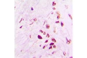 Immunohistochemical analysis of p53 staining in human lung cancer formalin fixed paraffin embedded tissue section. (p53 Antikörper  (C-Term))