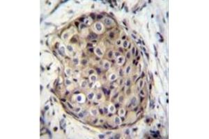 Immunohistochemistry analysis in formalin fixed and paraffin embedded human breast carcinoma reacted with GMP reductase 1 / GMPR1 Antibody (C-term) followed by peroxidase conjugation of the secondary antibody and DAB staining. (GMPR Antikörper  (C-Term))