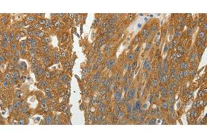 Immunohistochemistry of paraffin-embedded Human ovarian cancer using RPLP0 Polyclonal Antibody at dilution of 1:40 (RPLP0 Antikörper)