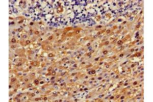 Immunohistochemistry of paraffin-embedded human liver cancer using ABIN7144595 at dilution of 1:100 (ASL Antikörper  (AA 2-300))