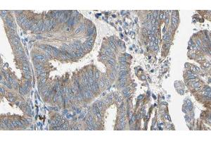 ABIN6274649 at 1/100 staining Human cervical cancer tissue by IHC-P. (CYP2E1 Antikörper  (Internal Region))