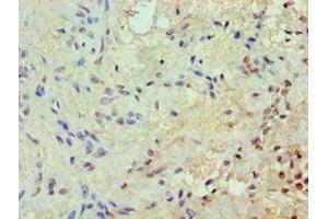 Immunohistochemistry of paraffin-embedded human breast cancer using ABIN7172569 at dilution of 1:100 (JunB Antikörper  (AA 1-240))