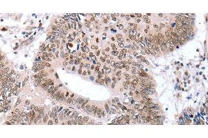 Immunohistochemistry of paraffin-embedded Human colon cancer tissue using TBX2 Polyclonal Antibody at dilution 1:32 (TBX2 Antikörper)