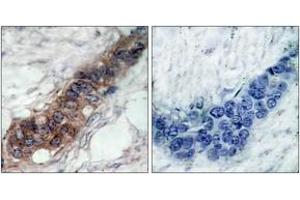 Immunohistochemistry analysis of paraffin-embedded human breast carcinoma tissue, using JAK2 (Ab-221) Antibody.