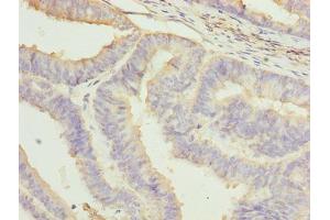 Immunohistochemistry of paraffin-embedded human endometrial cancer using ABIN7161717 at dilution of 1:100 (NRARP Antikörper  (AA 1-114))