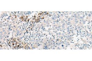 Immunohistochemistry of paraffin-embedded Human cervical cancer tissue using GUCA1B Polyclonal Antibody at dilution of 1:45(x200)
