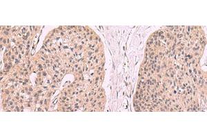 Immunohistochemistry of paraffin-embedded Human esophagus cancer tissue using KLRB1 Polyclonal Antibody at dilution of 1:55(x200) (CD161 Antikörper)