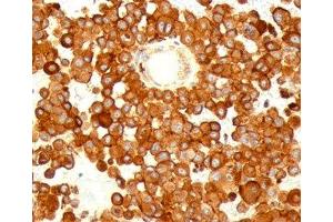 IHC testing of human melanoma stained with CD63 antibody (MX49. (CD63 Antikörper)